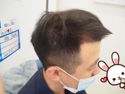 -大麦微针植发丨全国连锁