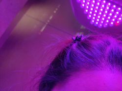 -碧莲盛·不剃发植发