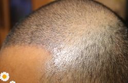 -大麦微针植发丨全国连锁