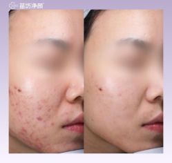 -苗坊净颜痘斑美容护肤连锁
