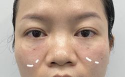 -天津健丽·去眼袋医疗美容机构