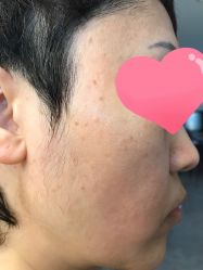 -美丽人生祛斑扁平疣汗管瘤中心
