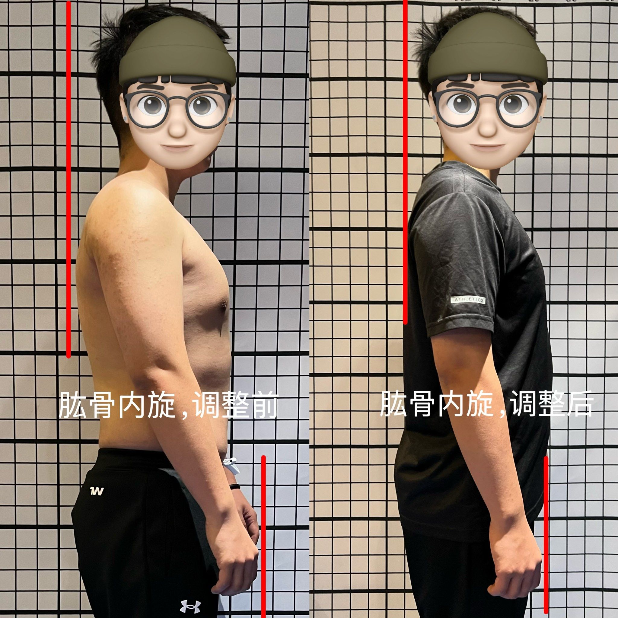 改变从骨骼做起,肱骨内旋,调整前后对比