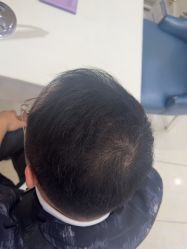 -大麦微针植发丨全国连锁