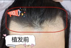 -大麦微针植发全国连锁