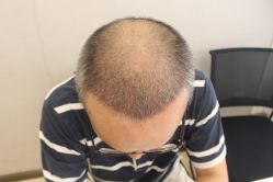 -大麦微针植发丨全国连锁