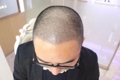 -大麦微针植发丨全国连锁