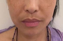 -海涛医疗美容·面部抗衰·注射美鼻