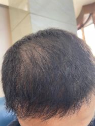 -大麦微针植发全国连锁