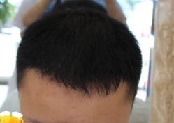 -大麦微针植发丨全国连锁