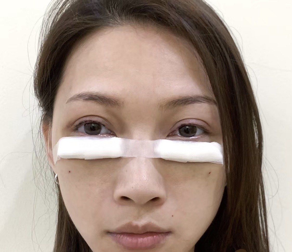 我的内切去眼袋体验