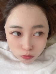 体验后-海涛医疗美容·面部抗衰·注射美鼻