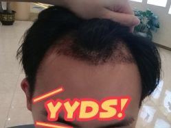 -大麦微针植发丨全国连锁