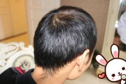 点击看大图 -大麦微针植发丨全国连锁