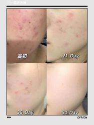 -苗坊净颜痘斑美容护肤连锁