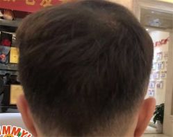 -大麦微针植发全国连锁