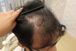 点击看大图 -大麦微针植发丨全国连锁