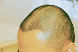 -大麦微针植发丨全国连锁