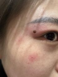 -北京美痣堂古方祛痣斑疣瘊