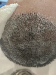 -碧莲盛·不剃发植发