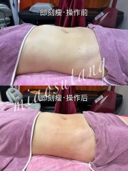 -苗塑堂减肥·艾灸