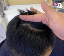 -大麦微针植发丨全国连锁
