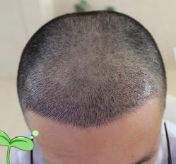 -大麦微针植发丨全国连锁