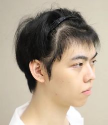 -大麦微针植发丨全国连锁