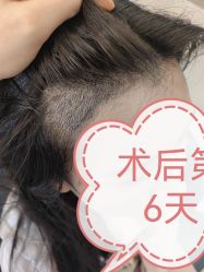 -大麦微针植发全国连锁