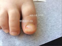 点击看大图 -德哥灰指甲脚气甲沟炎跖疣护理