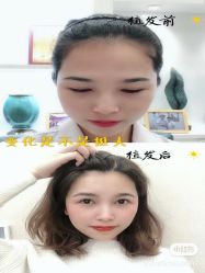 -大麦微针植发全国连锁