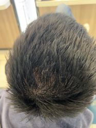 -大麦微针植发丨全国连锁