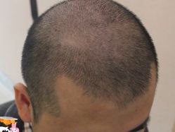 -大麦微针植发丨全国连锁