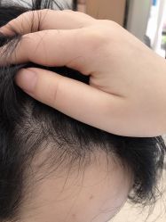 点击看大图 -大麦微针植发丨全国连锁