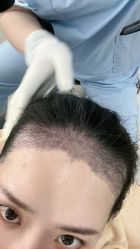 -大麦微针植发丨全国连锁