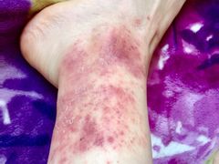 -大韩庄韩氏祖传正骨