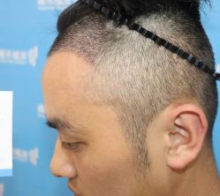 -雍禾植发全国连锁