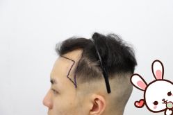 -大麦微针植发丨全国连锁