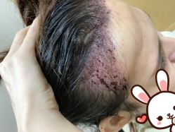 -大麦微针植发丨全国连锁