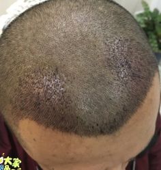 -大麦微针植发丨全国连锁