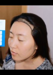 体验前-大麦微针植发全国连锁