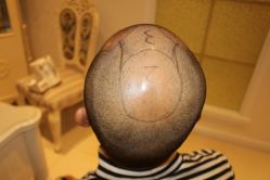 -大麦微针植发丨全国连锁