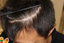 -大麦微针植发丨全国连锁