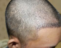 -大麦微针植发全国连锁