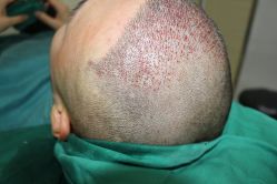 -大麦微针植发丨全国连锁