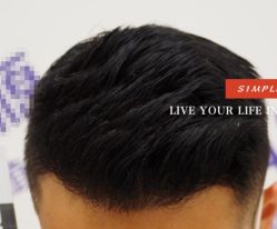 -大麦微针植发全国连锁