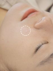 -清疣美疣·痣·斑净肤中心