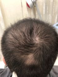点击看大图 -大麦微针植发全国连锁