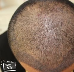 -大麦微针植发丨全国连锁