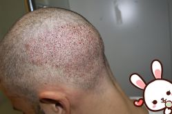 -大麦微针植发丨全国连锁